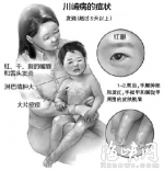 福州一男婴“感冒”险些丧命　原来是染上川崎病 - 福州新闻网