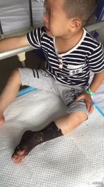 漳州3岁男童出去串门 被竹叶青蛇咬伤左脚 - 新浪
