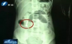 福州6岁儿童腹痛拍片吓坏医生 肚子里竟有串手链 - 新浪