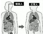 三明首例“镜面人”手术成功 肝内胆管布满结石 - 新浪