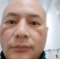 叶勇在宜昌市第三医院参加疫情防控工作，长时间佩戴护目镜和口罩的脸上被压出两道红肿印痕。　供图 - 福建新闻