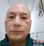 叶勇在宜昌市第三医院参加疫情防控工作，长时间佩戴护目镜和口罩的脸上被压出两道红肿印痕。　供图 - 福建新闻